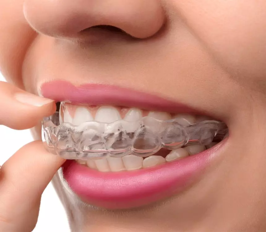 INVISIBLE ALIGNERS TREATMENT IN INDIA