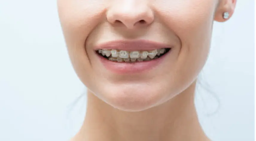 clear aligners for overbite