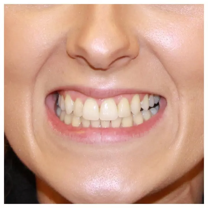 Crowded teeth After Aligners