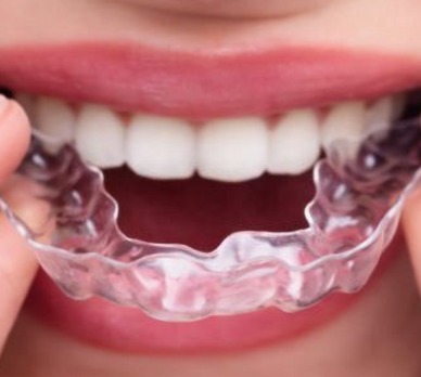 Five Benefits of Invisible Clear Aligners Over Metal Braces