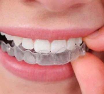 Do's And Don'ts of Eating With Invisible Braces/Clear Aligners