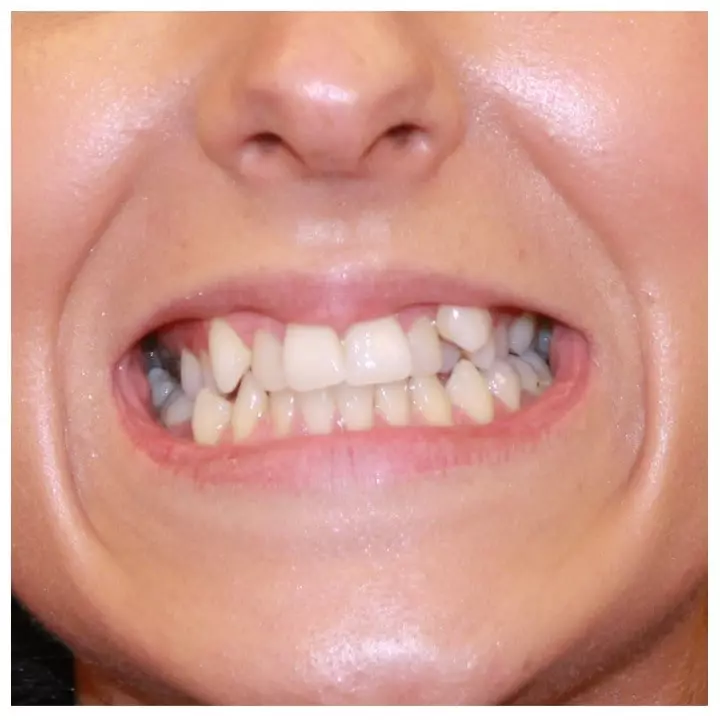 Crowded teeth Before Aligners