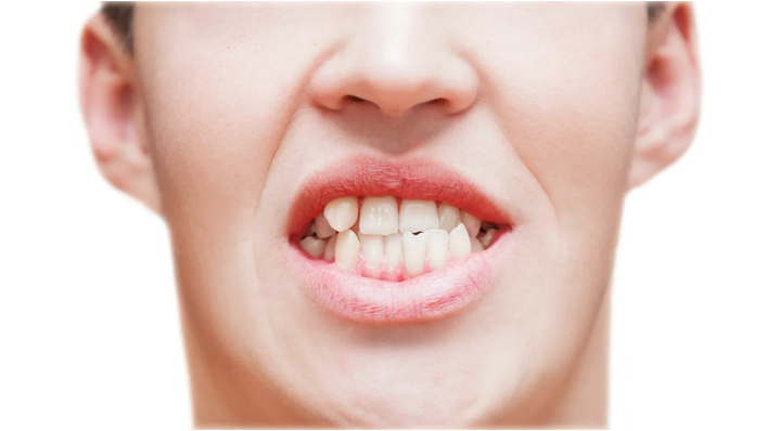 Close-up of a girl mouth showing misaligned & crowded teeth, an early sign of abnormal tooth eruption