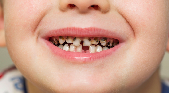Clear aligners treat abnormally erupted teeth in children & help them achieve a healthy, confident smile.