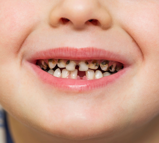 How Clear Aligners Correct Abnormal Tooth Eruption in Kids How Clear Aligners Correct Abnormal Tooth Eruption in Kids