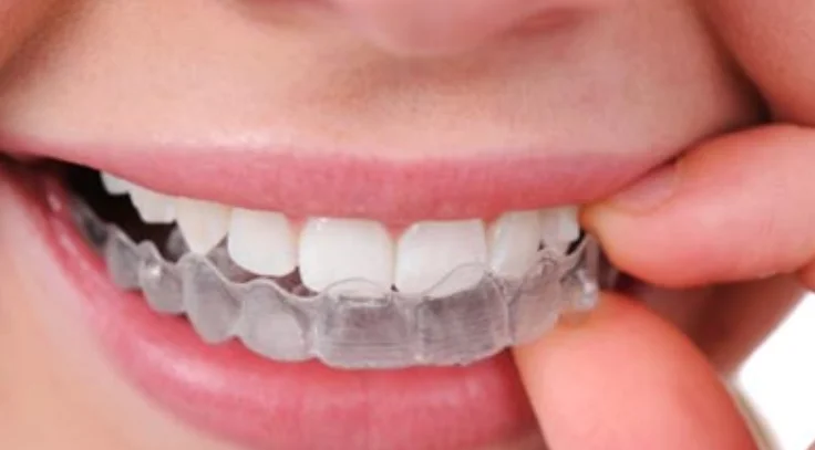 Invisible Clear Aligners for Teeth Straightening