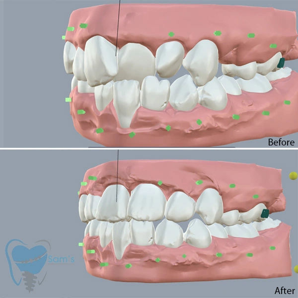 Invisible Dental Braces treatment