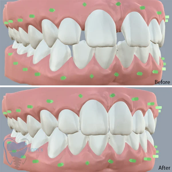 Invisalign Treatment in Coimbatore