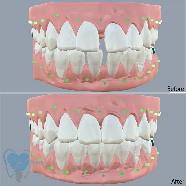 Clear Aligners Treatment Plan in Tamil Nadu