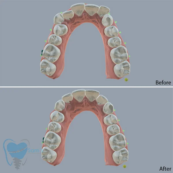 Teeth Straightening Treatment in Coimbatore