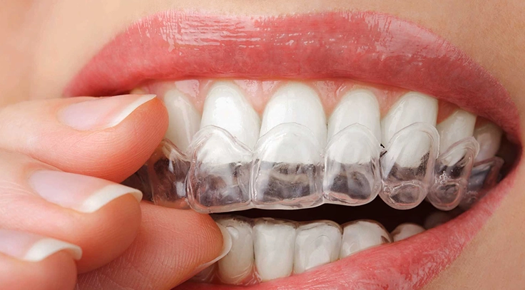 Choose invisible braces in Madurai to treat crowded teeth with comfort and great results.
