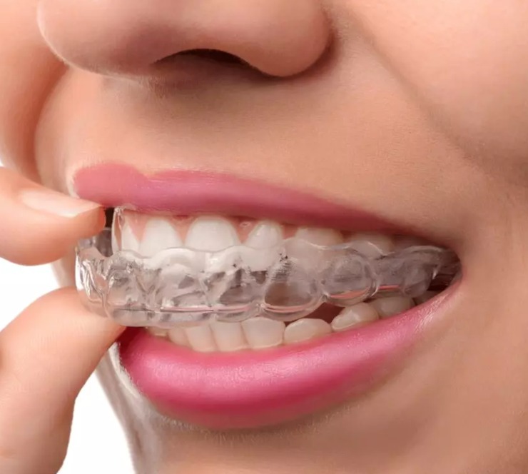 How do clear aligners straighten the teeth?