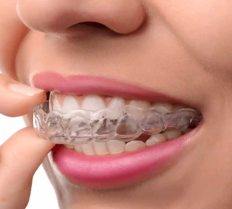 How do clear aligners straighten the teeth?