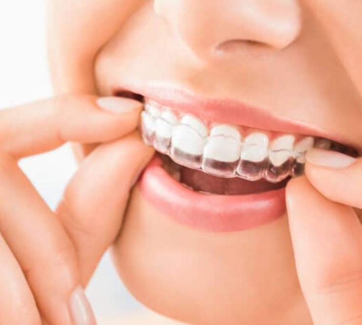 Top 5 Benefits of Clear Aligners for Straightening Teeth