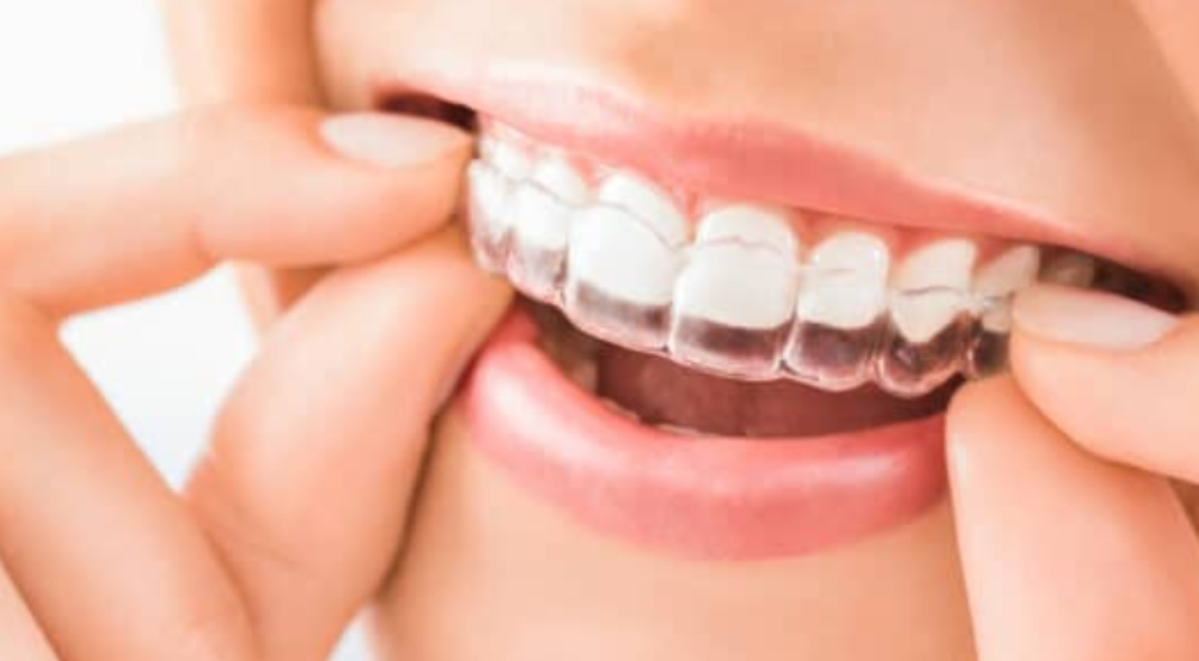 Clear Aligners for Straightening Teeth