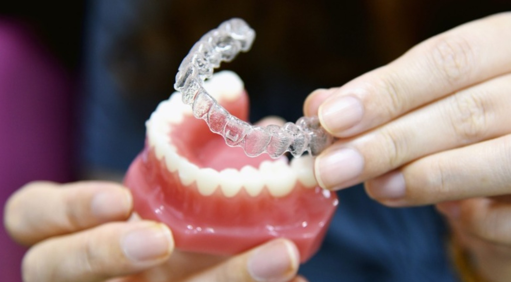 Invisible Aligners for Straightening Teeth