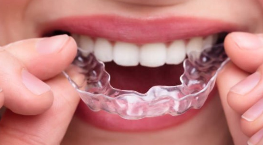 Straightening Teeth With Clear Aligners