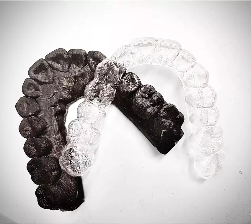 Invisible Aligners treatment in Coimbatore